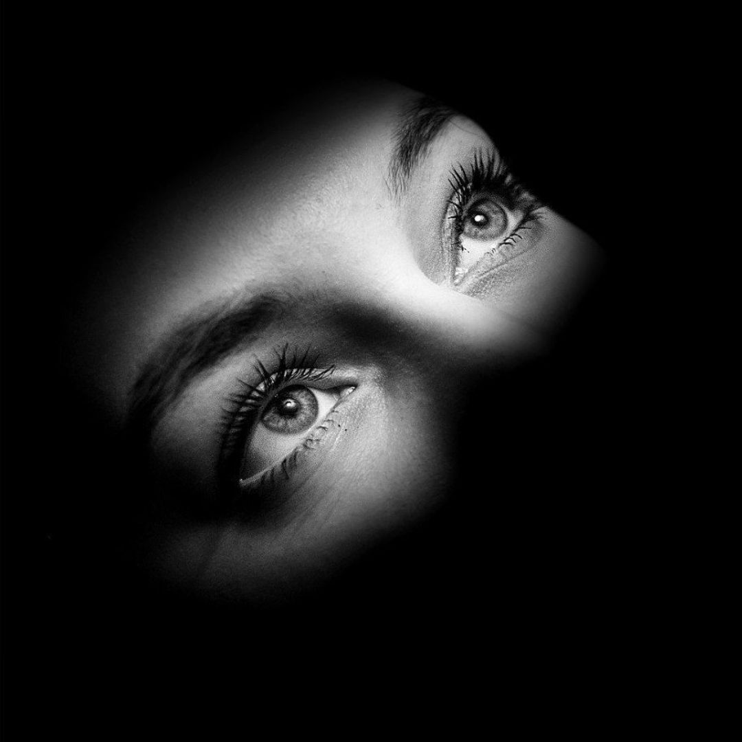 Blepharoplasty upper eyelid surgery by Dr. Akash at SculptDerma